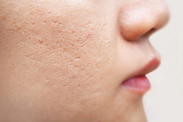 Acne Scar Treatment in PCMC, Pune showing visible acne scars on skin before treatment