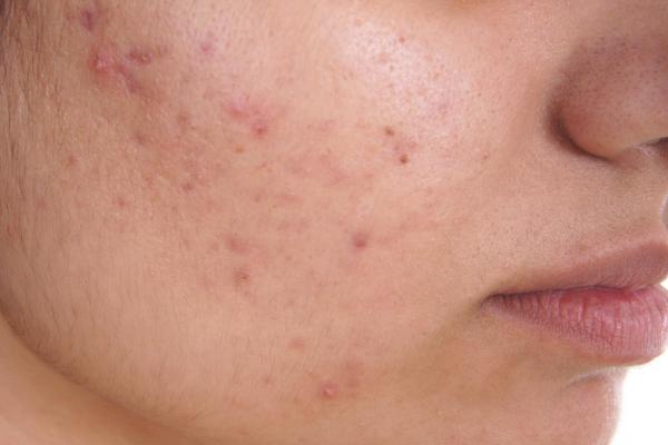 Acne Treatment In Pune by Dr. Ruchi Bhirud consultation