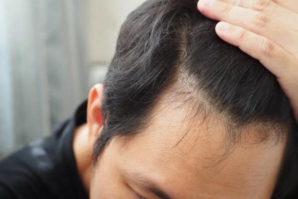 Hair Fall treatment in PCMC, Pune for hair loss control and hair regrowth