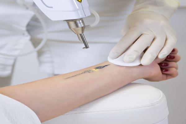 Laser tattoo removal in pcmc pune for safe and effective tattoo removal treatment