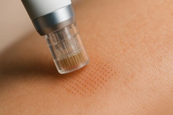 Micro needling treatment in pcmc pune for acne scars and skin rejuvenation