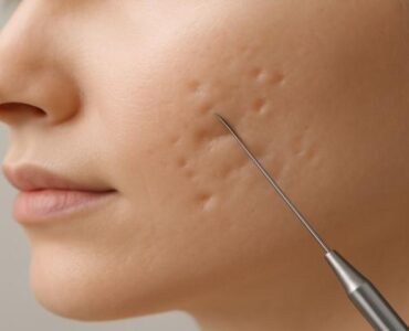 Acne Leaving Permanent Scars