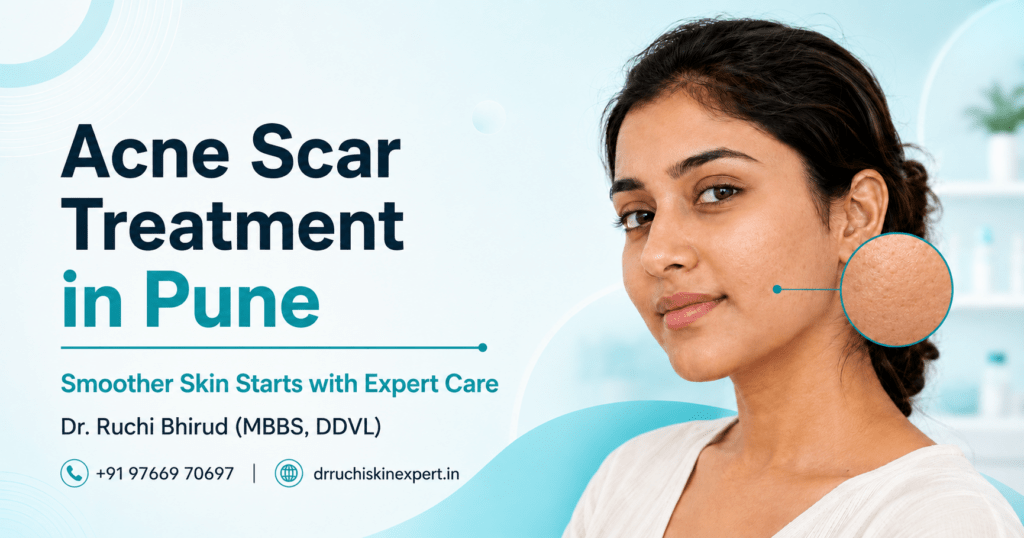 Acne Scar Treatment in Pune banner featuring Dr. Ruchi Bhirud (MBBS, DDVL) skin specialist