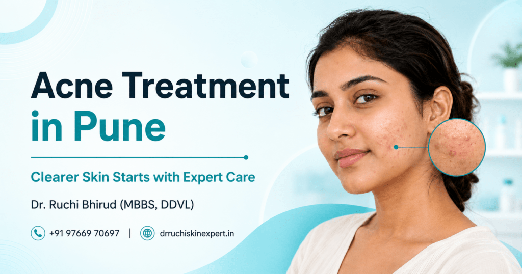 Acne Treatment in Pune banner featuring Dr. Ruchi Bhirud (MBBS, DDVL) skin specialist
