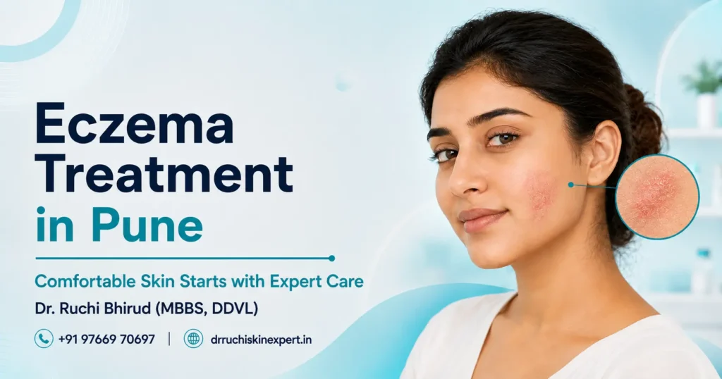 Eczema Treatment in Pune banner featuring Dr. Ruchi Bhirud (MBBS, DDVL) skin specialist